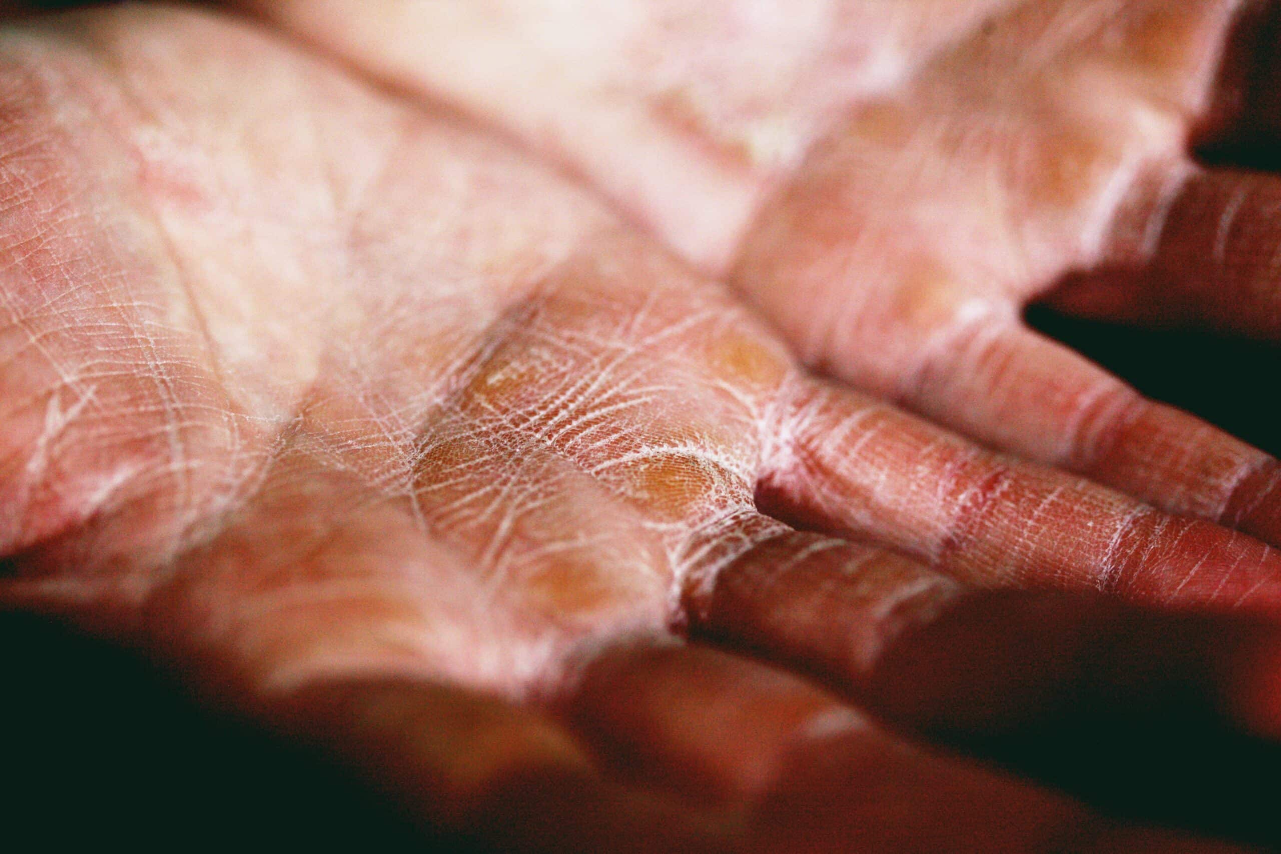 Image of a person's open palms. The skin on the person's hands is dry, rough, and in need of the healing benefits of shea butter.