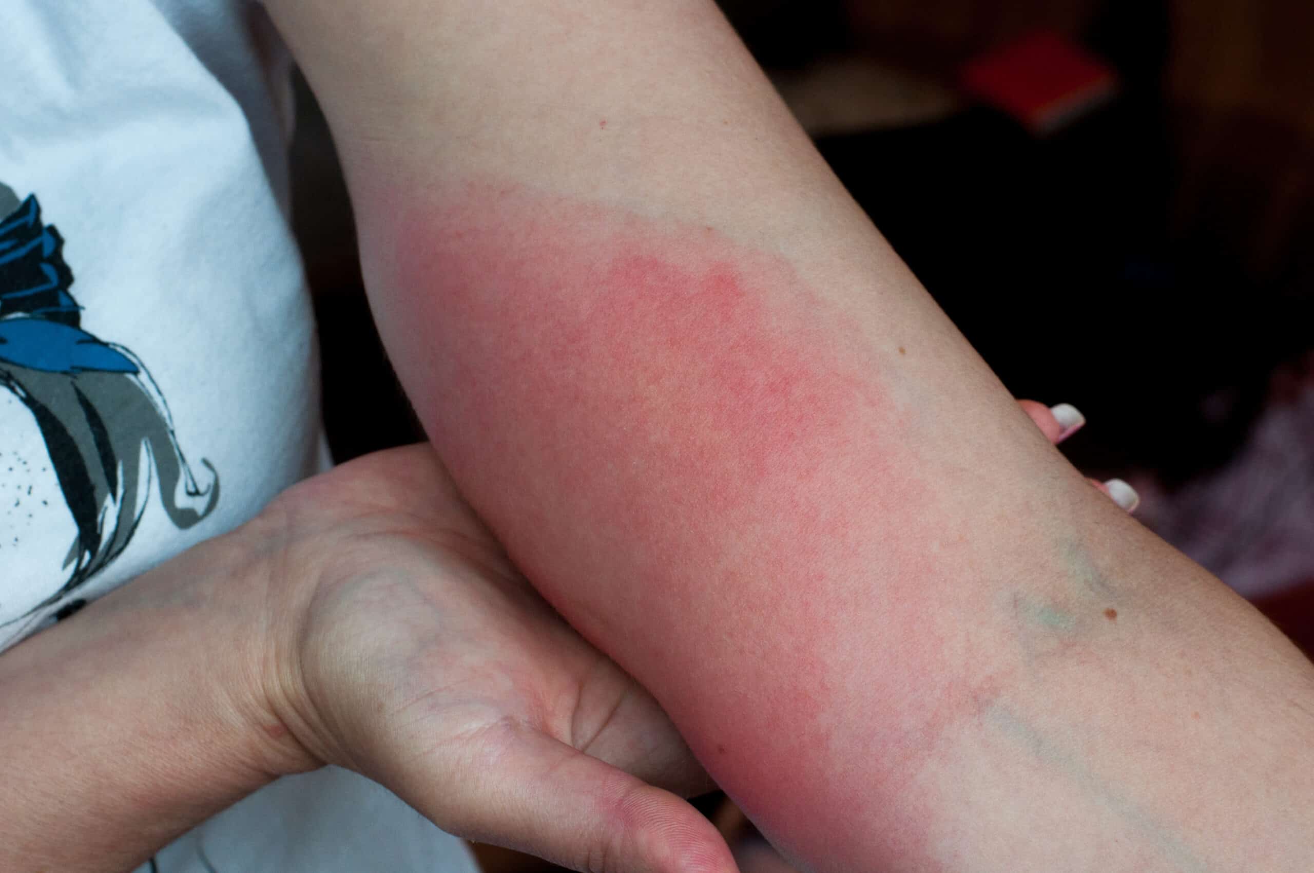 Image of a red insect sting shows an example acute inflammation